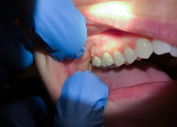 Best Teeth Whitening  in Marion, IL